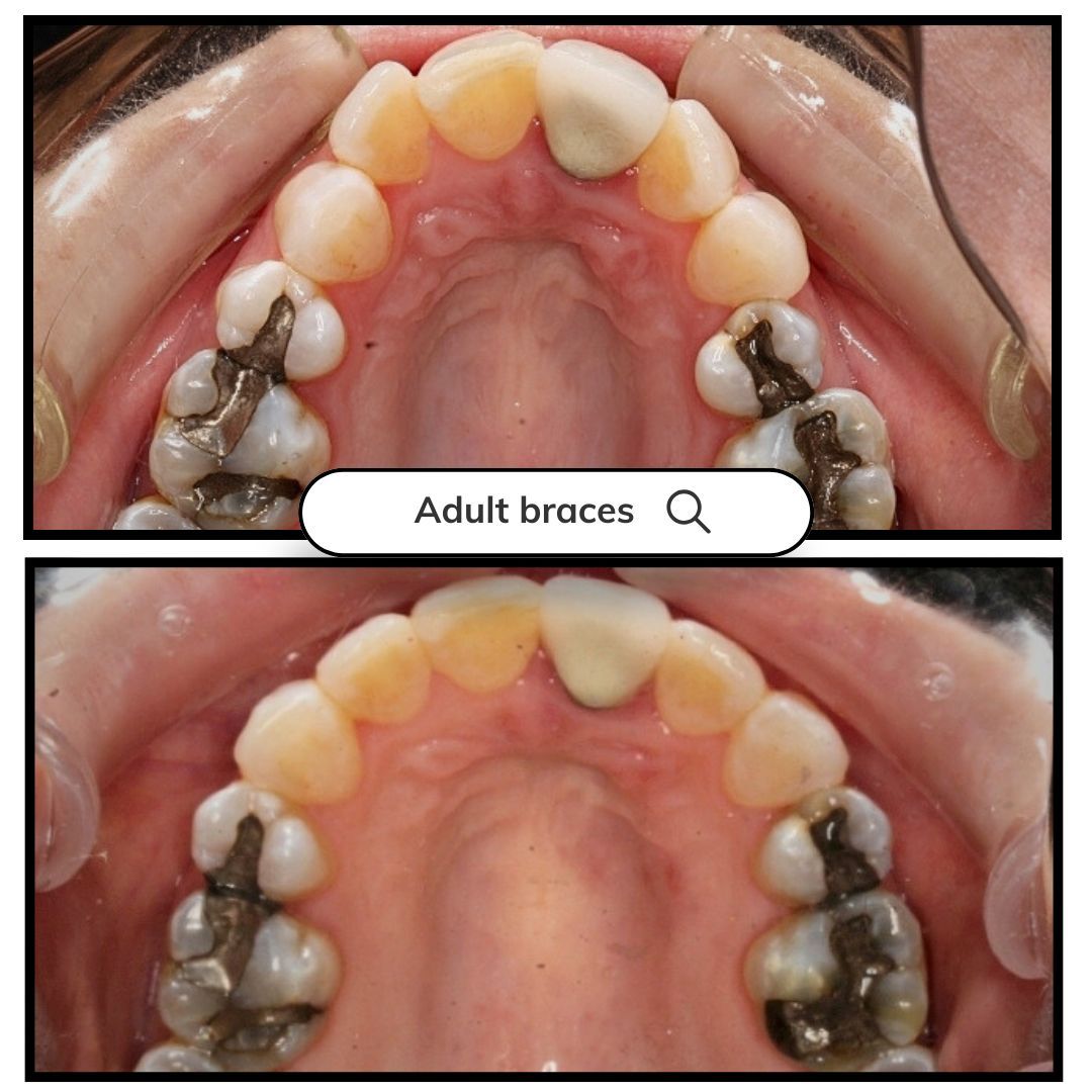 Two photos of the upper dental arch. Teeth show fillings and varying shades of yellow.