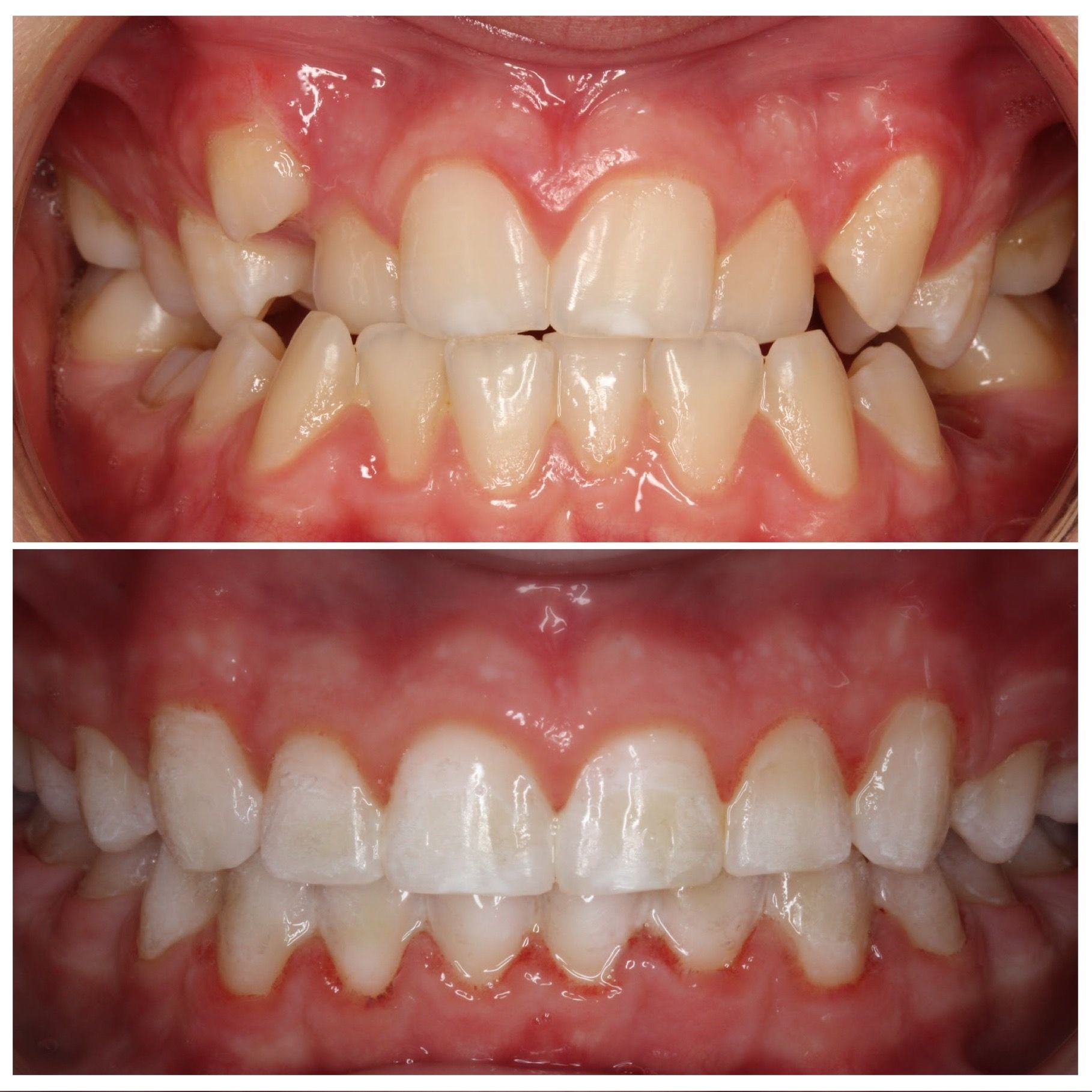 A before and after picture of a person 's teeth