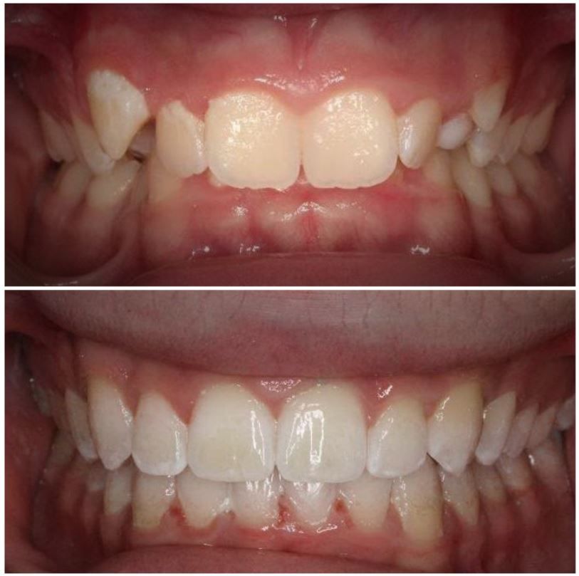 A before and after picture of a person 's teeth