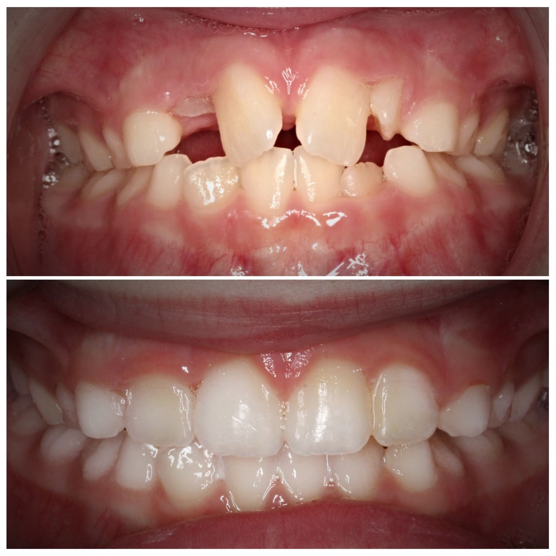A before and after picture of a child 's teeth