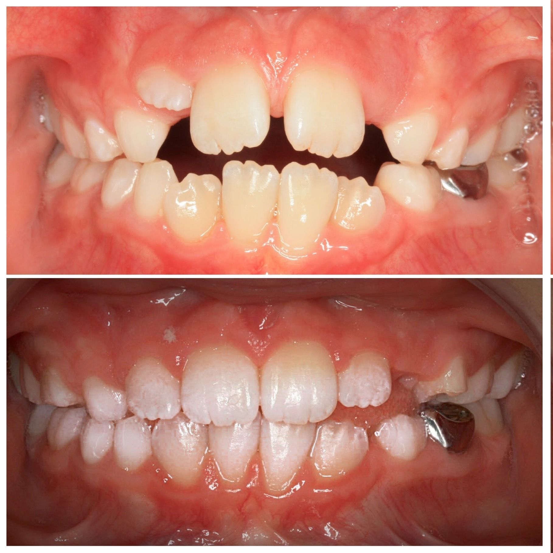 A before and after picture of a child 's teeth