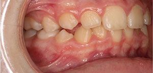 A close up of a person 's teeth and mouth.