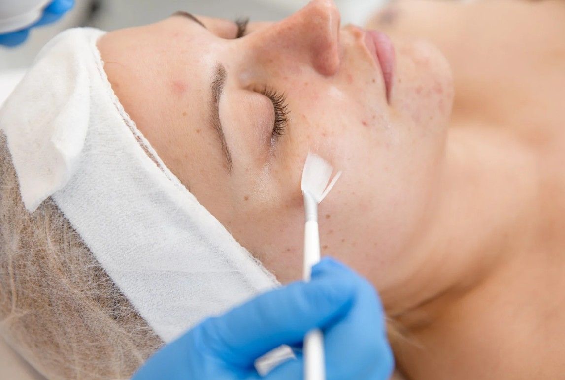 The Skin Studio applying glycolic acid serum.
