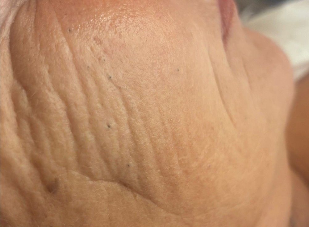 Client skin before professional blackhead removal at The Skin Studio, Arnold Nottingham — blackheads visible across the cheek and jaw