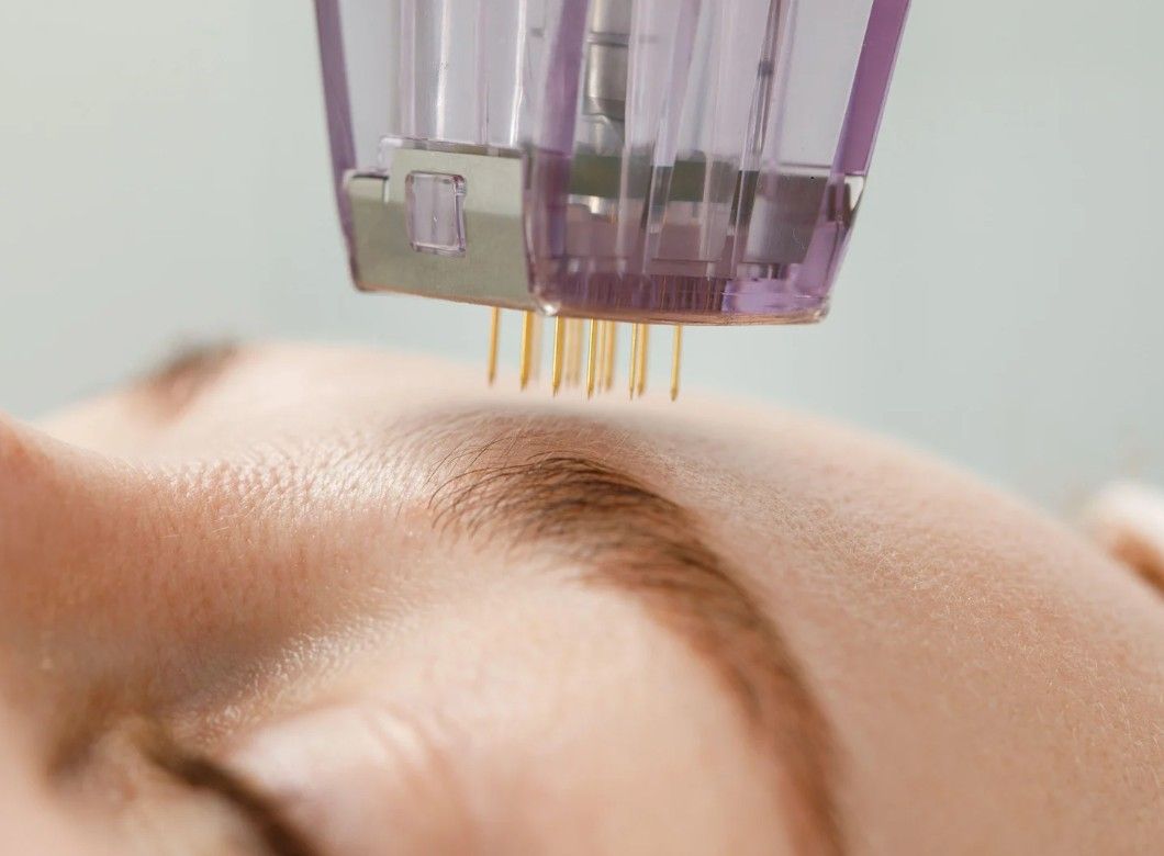 The Skin Studio about to start microneedling the forehead of a client in Nottingham