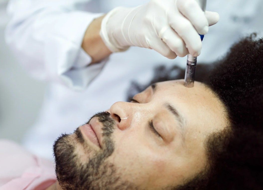 The Skin Studio microneedling a male client in Nottingham with a SkinPen 