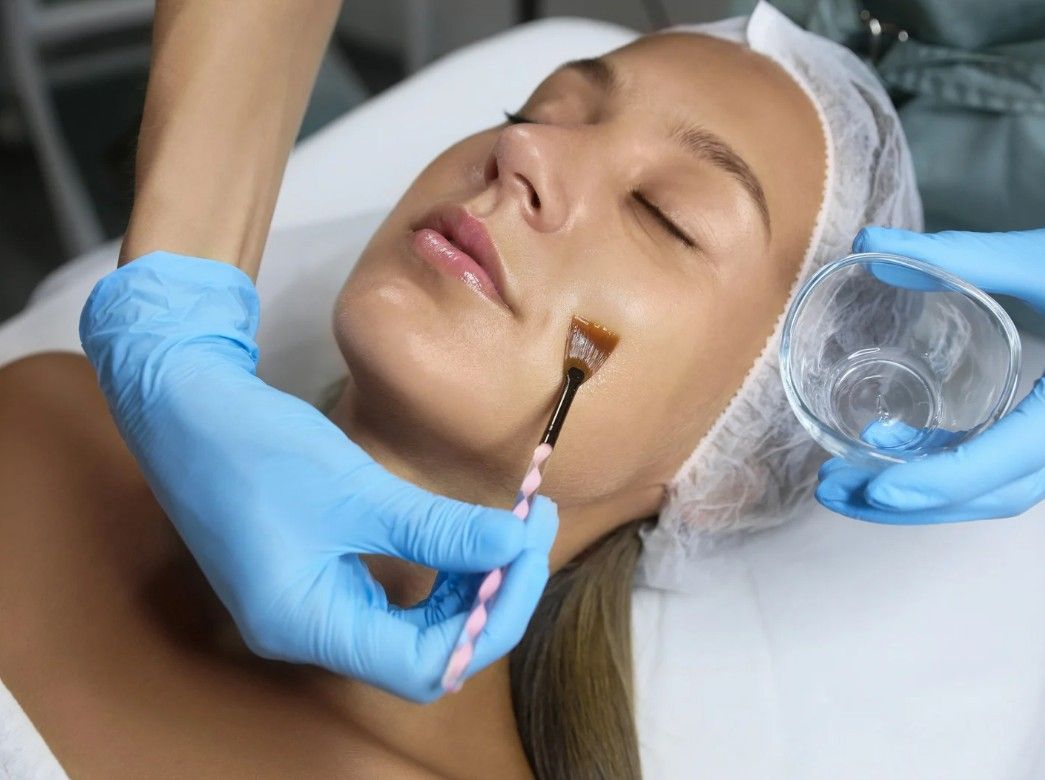 client having chemical peel applied to their ckin in Nottingham