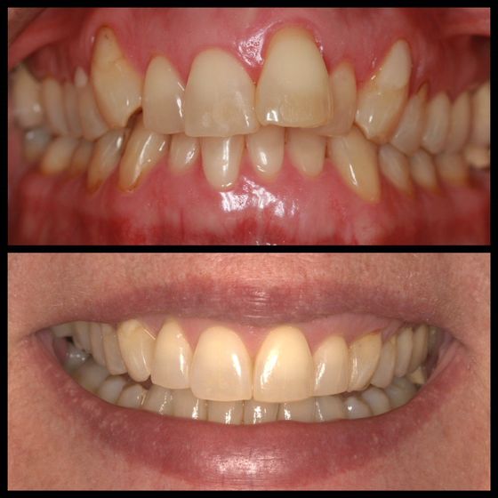 Before and after wearing braces near Dutch Harbor, AK