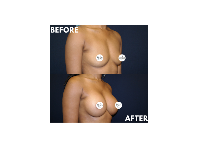Breast Augmentation with silicon in Beverly Hills