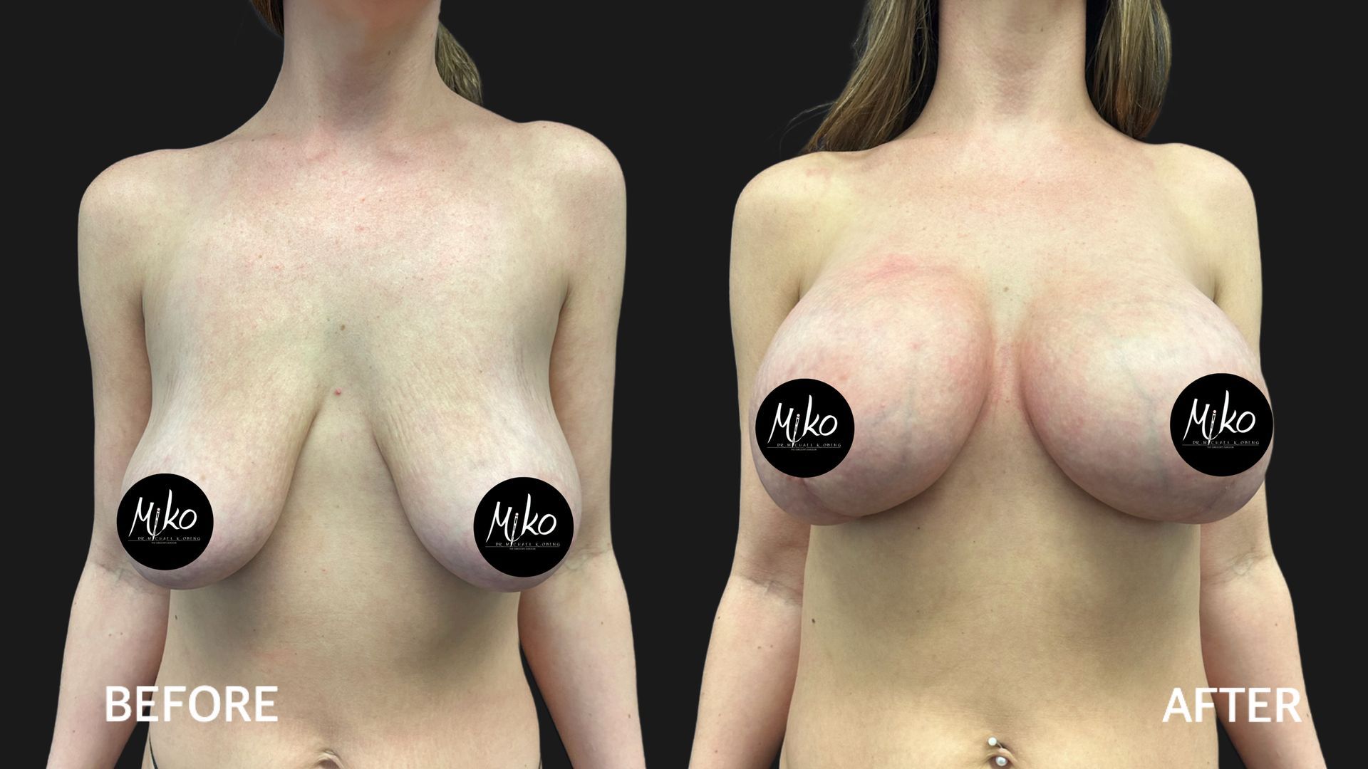 Breast Augmentation with inner lift to prevent breast lift scar
