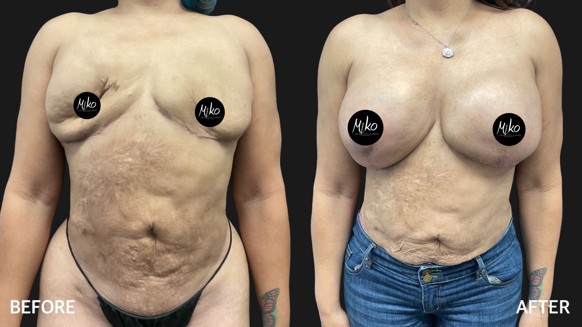 Image: A side-by-side comparison of a woman before and after breast reconstruction surgery. The before image depicts a woman's chest area with asymmetry or absence of one or both breasts. The after image shows the same woman post-surgery with reconstructed breasts, achieving a more symmetrical and natural appearance.