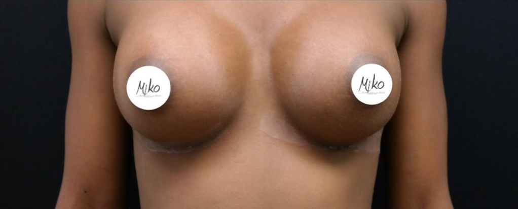 Breast Augmentation in Beverly Hills