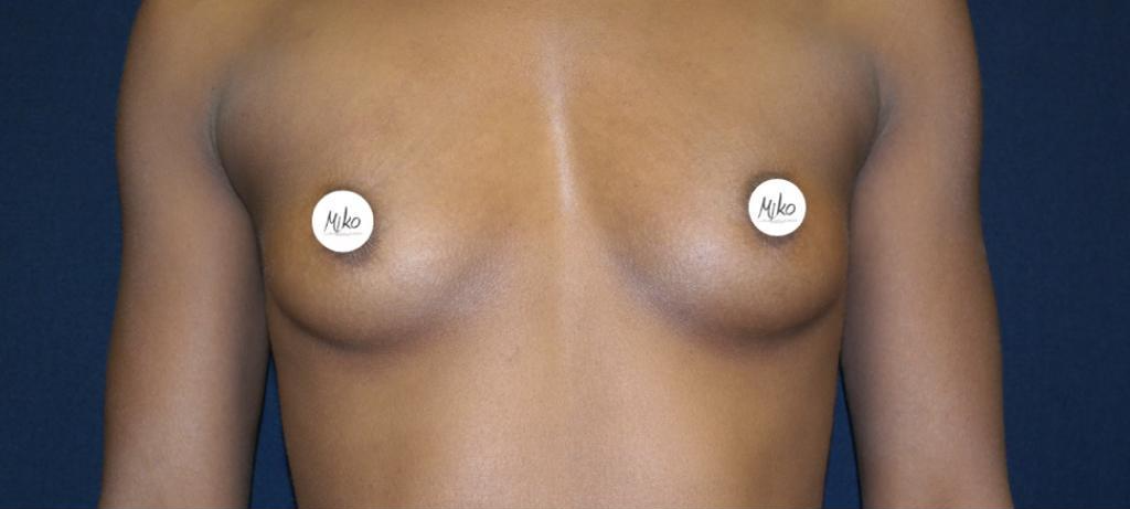 Breast augmentation in Beverly Hills