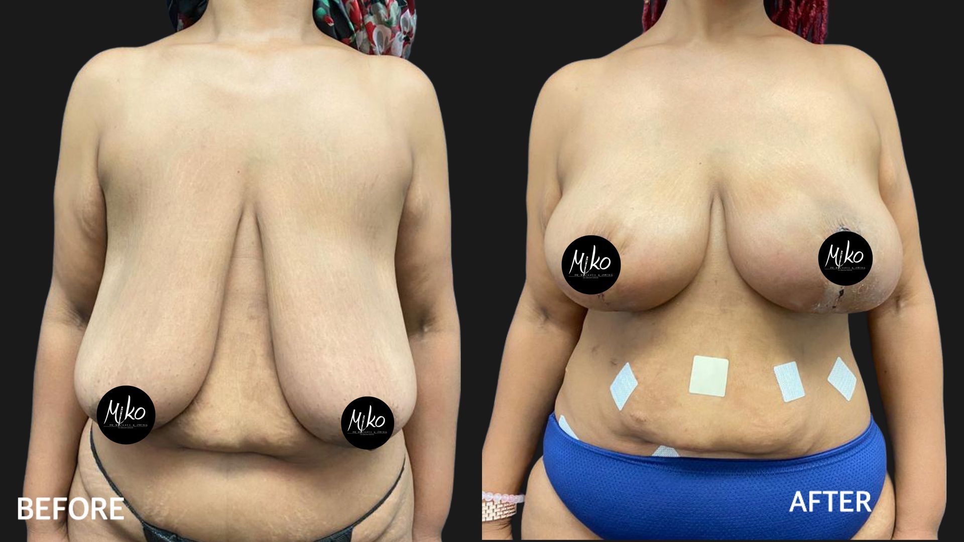 Discover the life-changing impact of breast reduction surgery through our before-and-after showcase. Witness the remarkable journey as women find relief from physical discomfort and emotional strain, achieving a more balanced and proportionate silhouette. Our gallery highlights the expertise of our surgeons in delivering transformative results, empowering individuals to embrace newfound comfort and confidence. Explore these inspiring stories of liberation and self-discovery, guiding you towards a path of enhanced well-being and empowerment.