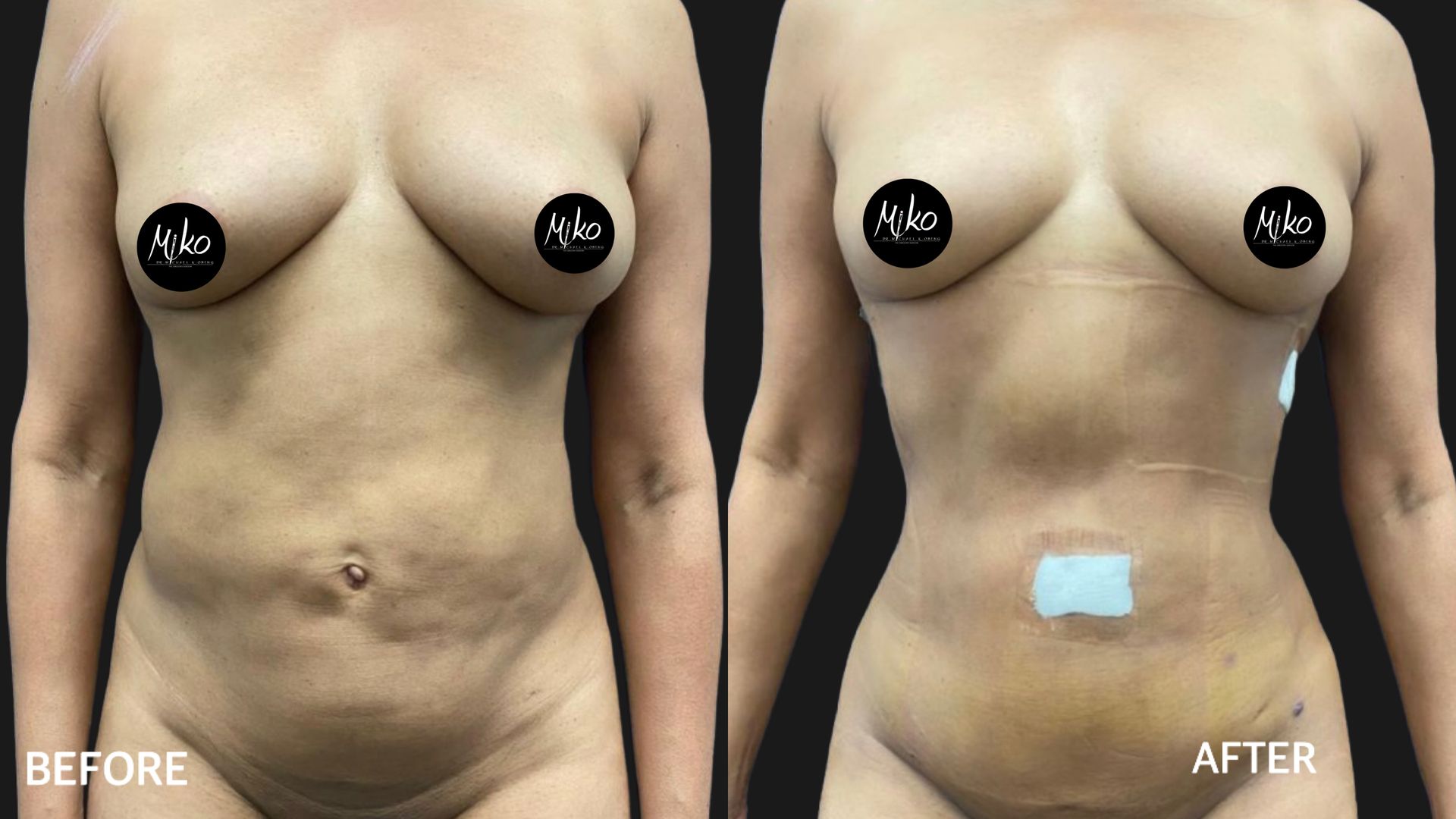 Before and after images showcasing the transformative effects of liposuction on body contours and silhouette refinement.