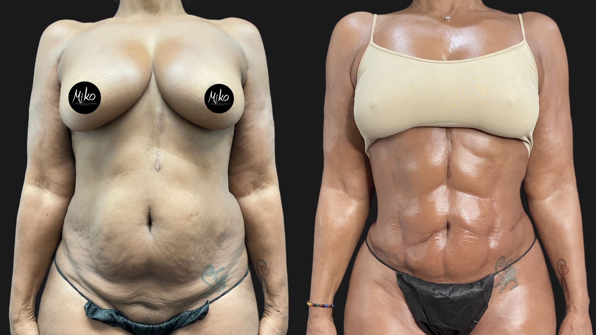 a before and after photo of a patient's Liposuction with Abdominal (Ab) Etching