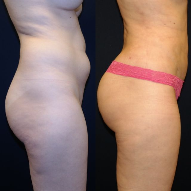 What liposuction recovery supplies should I gather before my surgery?