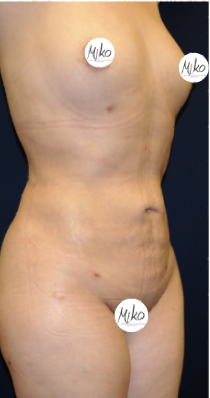 Circumferential Liposuction in Beverly Hills