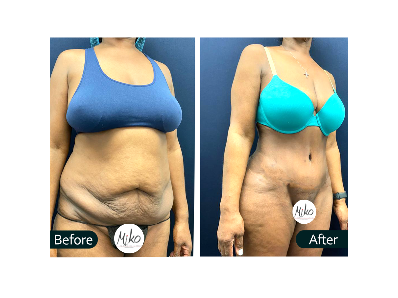 A before and after photo of a woman 's stomach.