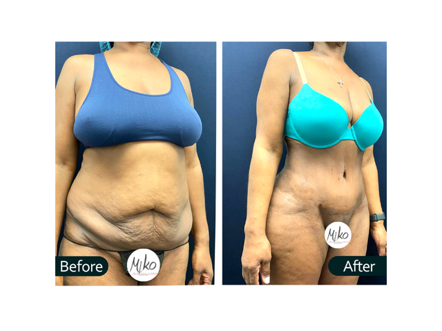 MOMMY MAKEOVER SERIES: POST-BREASTFEEDING BREAST AUGMENTATION