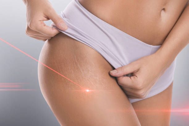 A woman in white underwear is getting a laser treatment on her stretch marks.