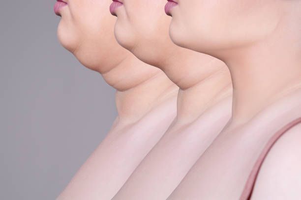 Three images of a woman 's neck before and after surgery.
