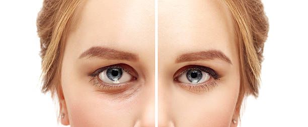 Eyelid surgery in Beverly Hills