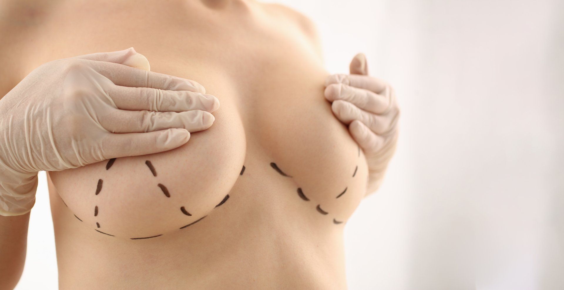 Breast reduction in Beverly Hills