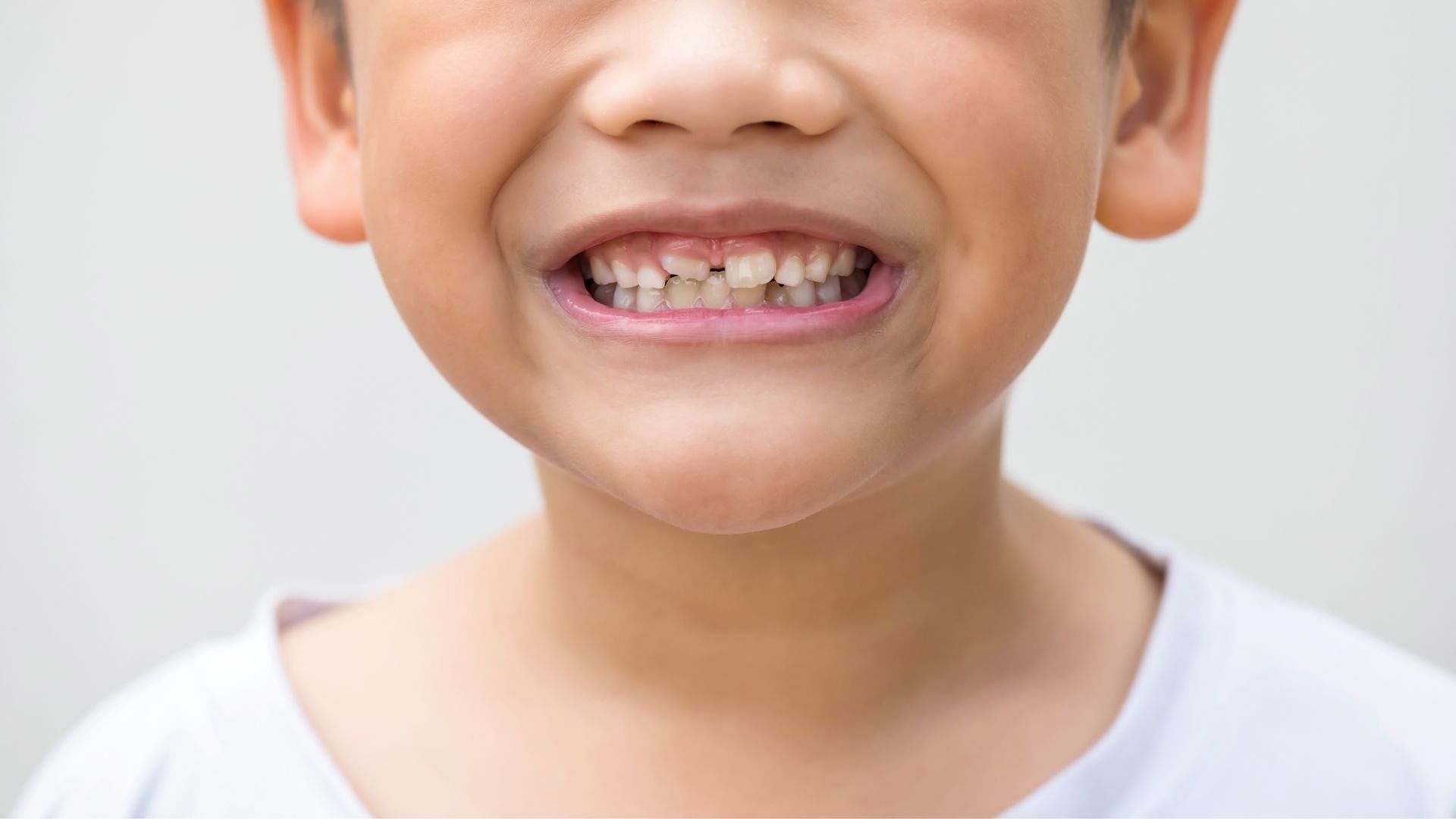 Vaikų dantų gydymas
