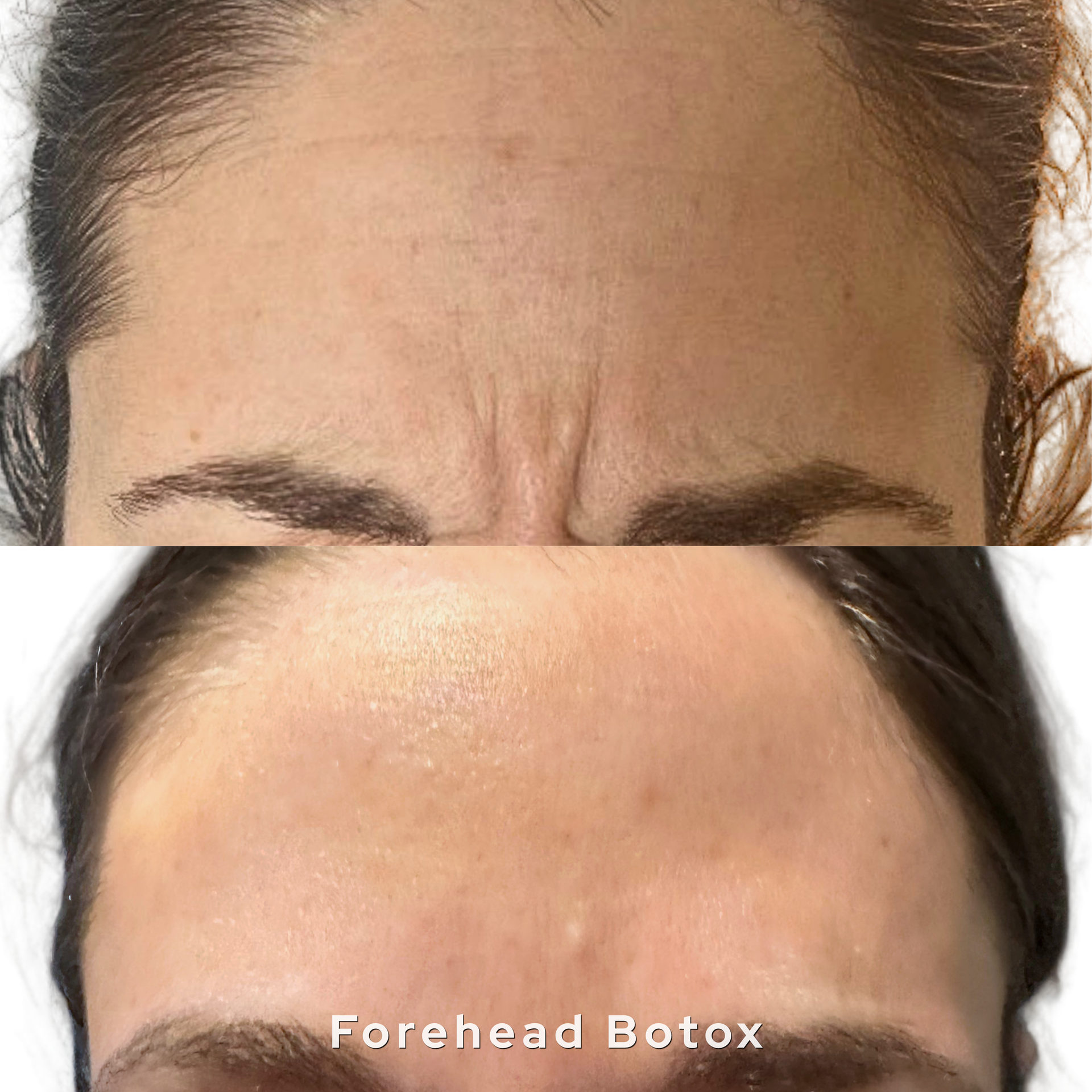 Botox before and after at AesTonic Med Spa Oklahoma City