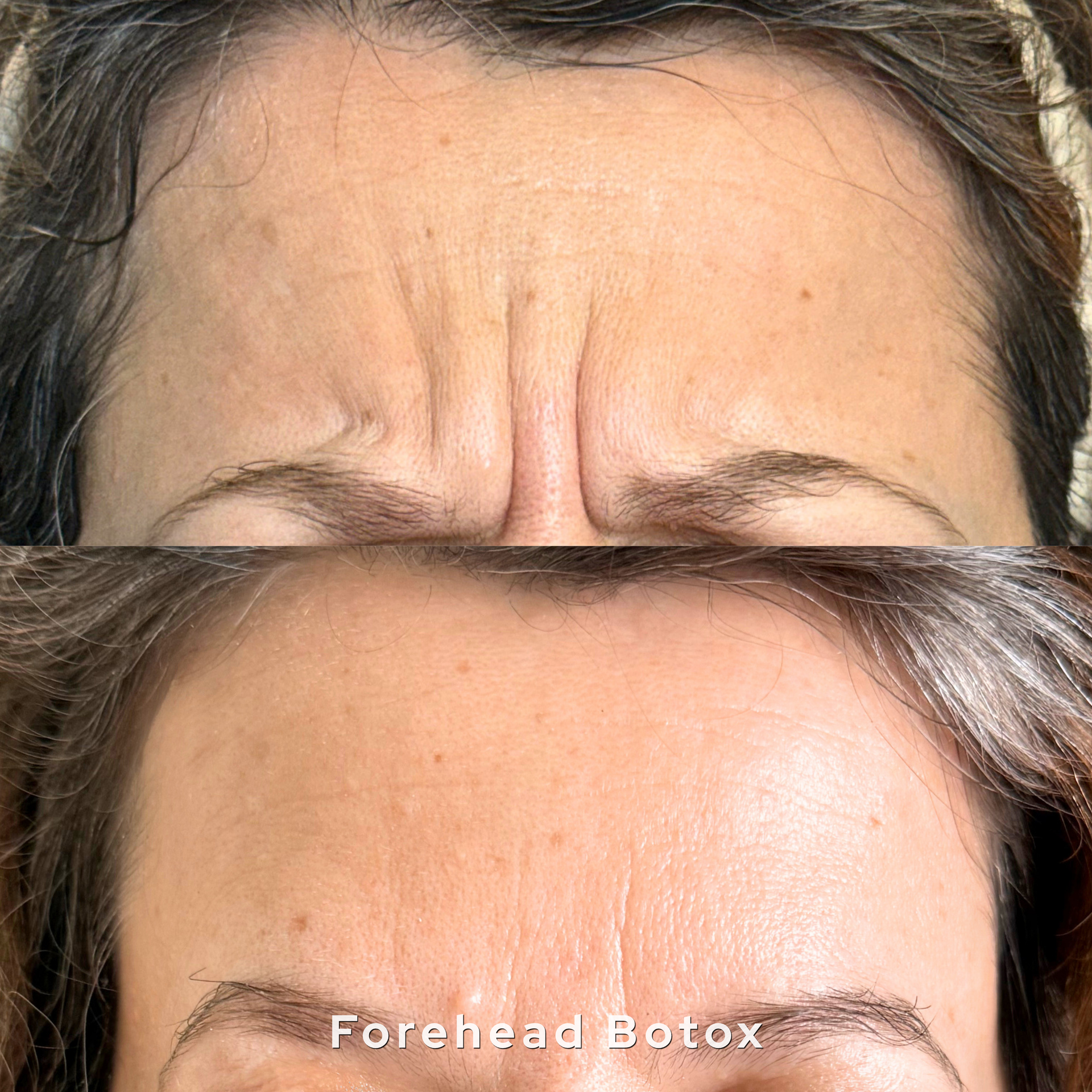Wrinkle relaxer results at AesTonic Med Spa OKC