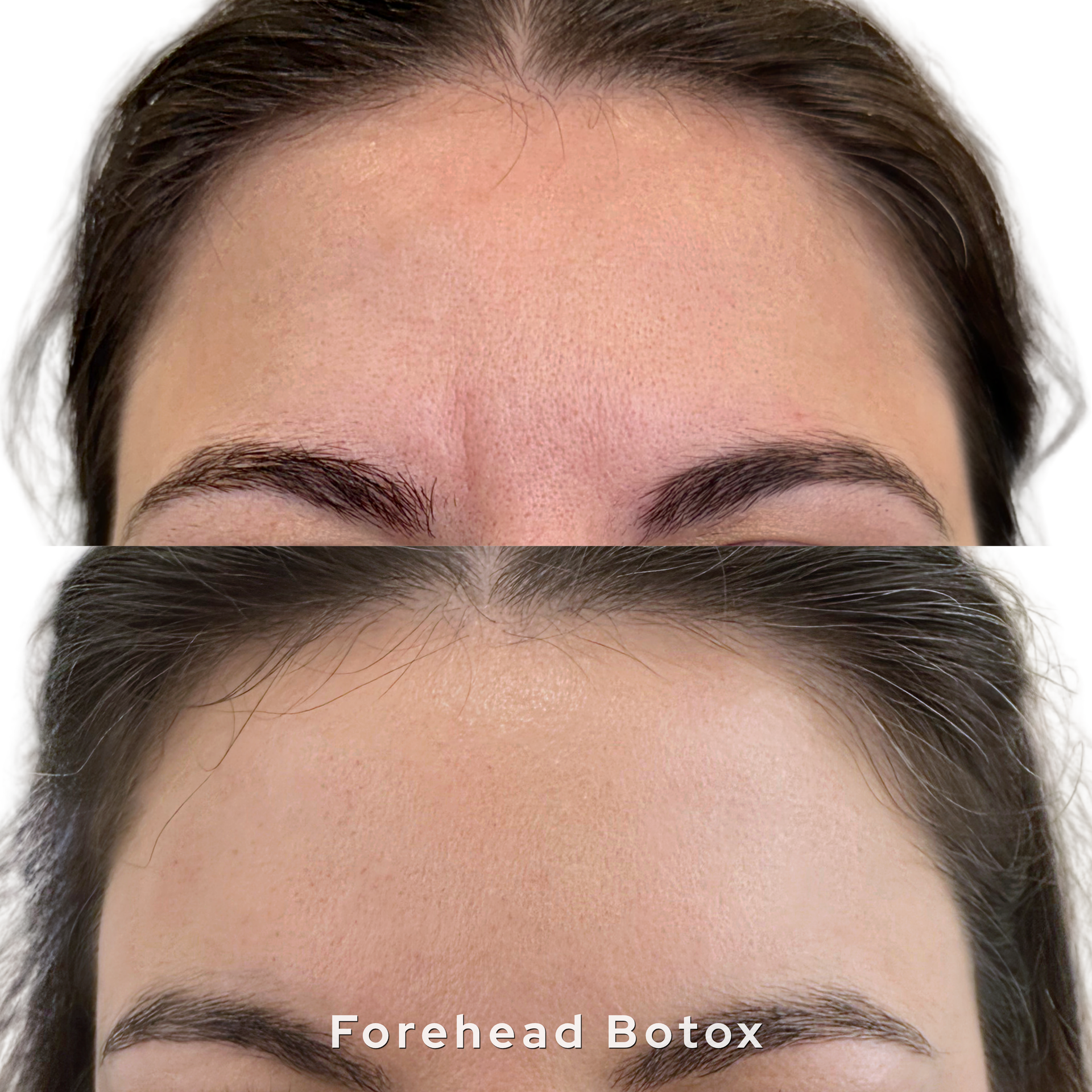 Botox Dysport before after Oklahoma City med spa