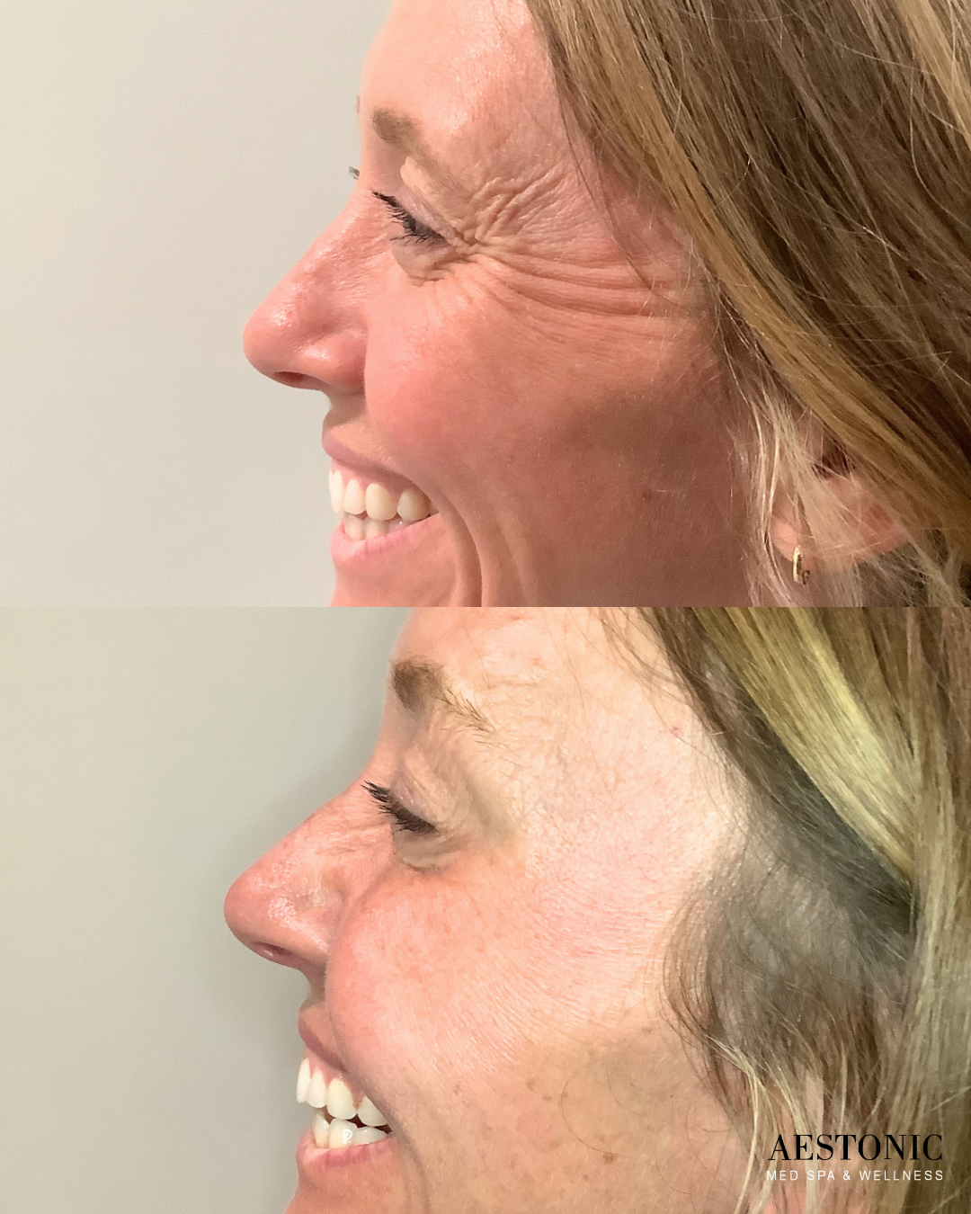 Crow's feet treatment before and after AesTonic