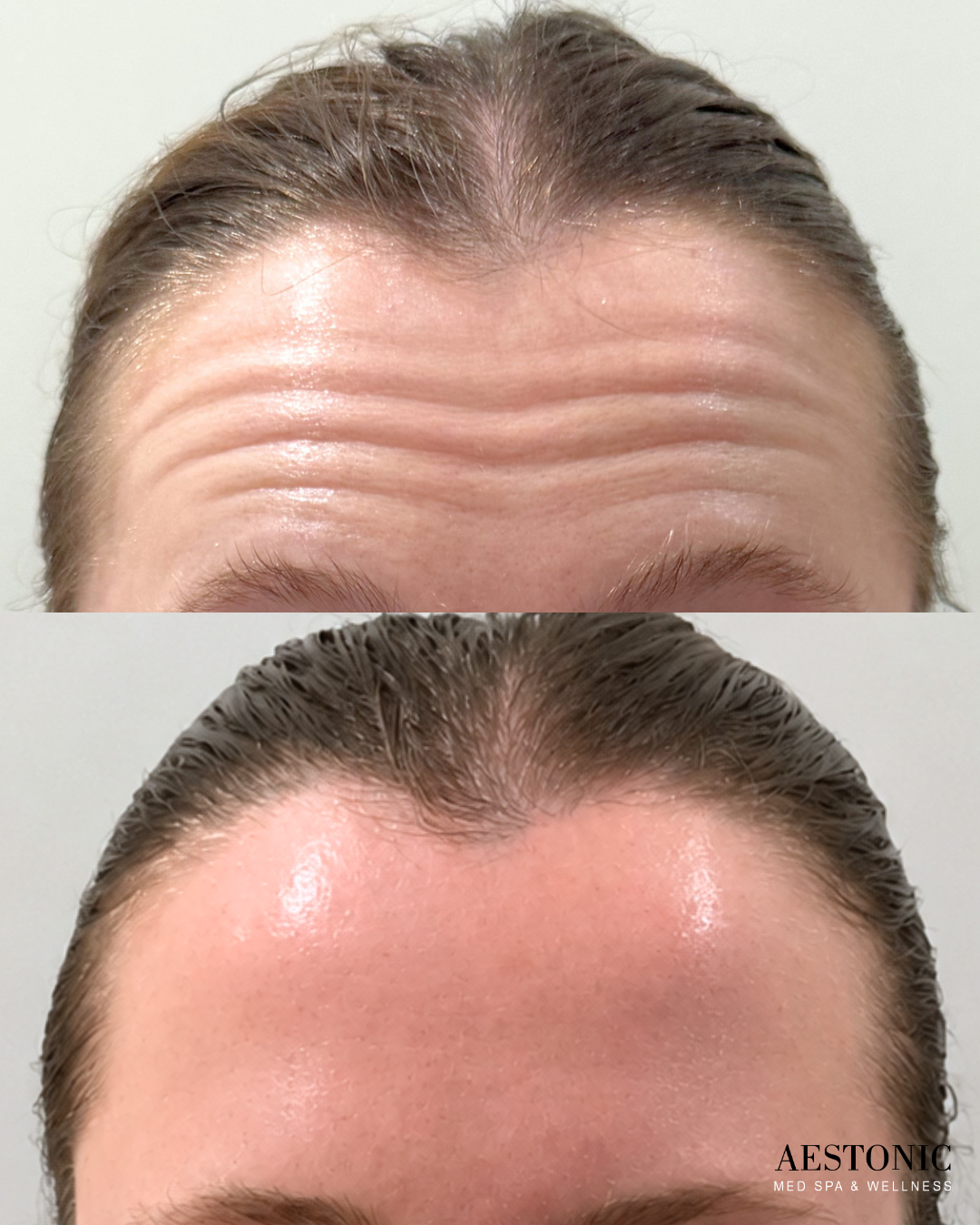 Botox Dysport wrinkle treatment results OKC
