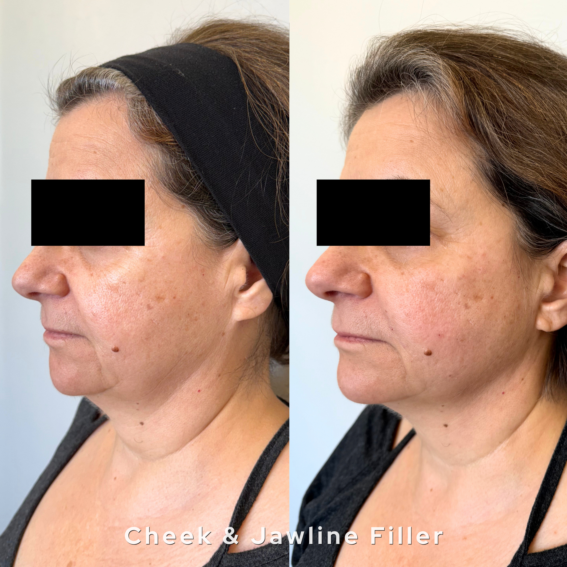 Face filler before and after at AesTonic Med Spa Oklahoma City