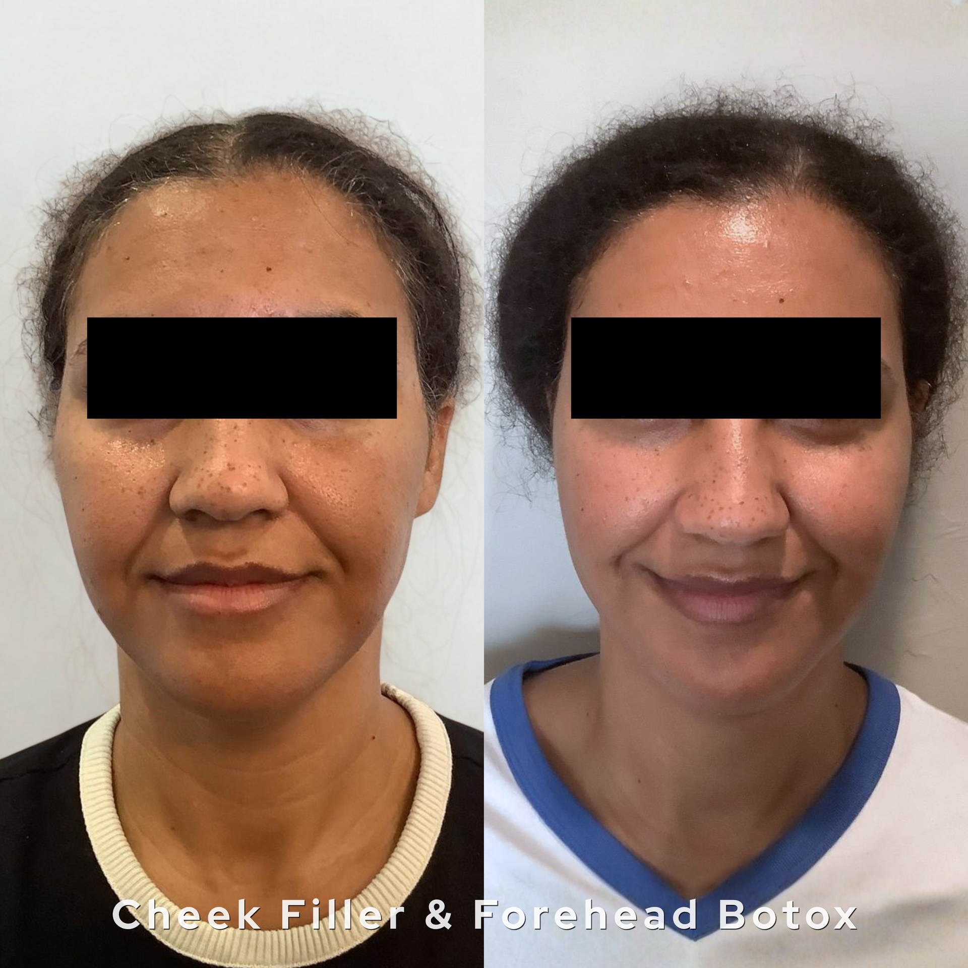 Face filler before and after results Oklahoma City