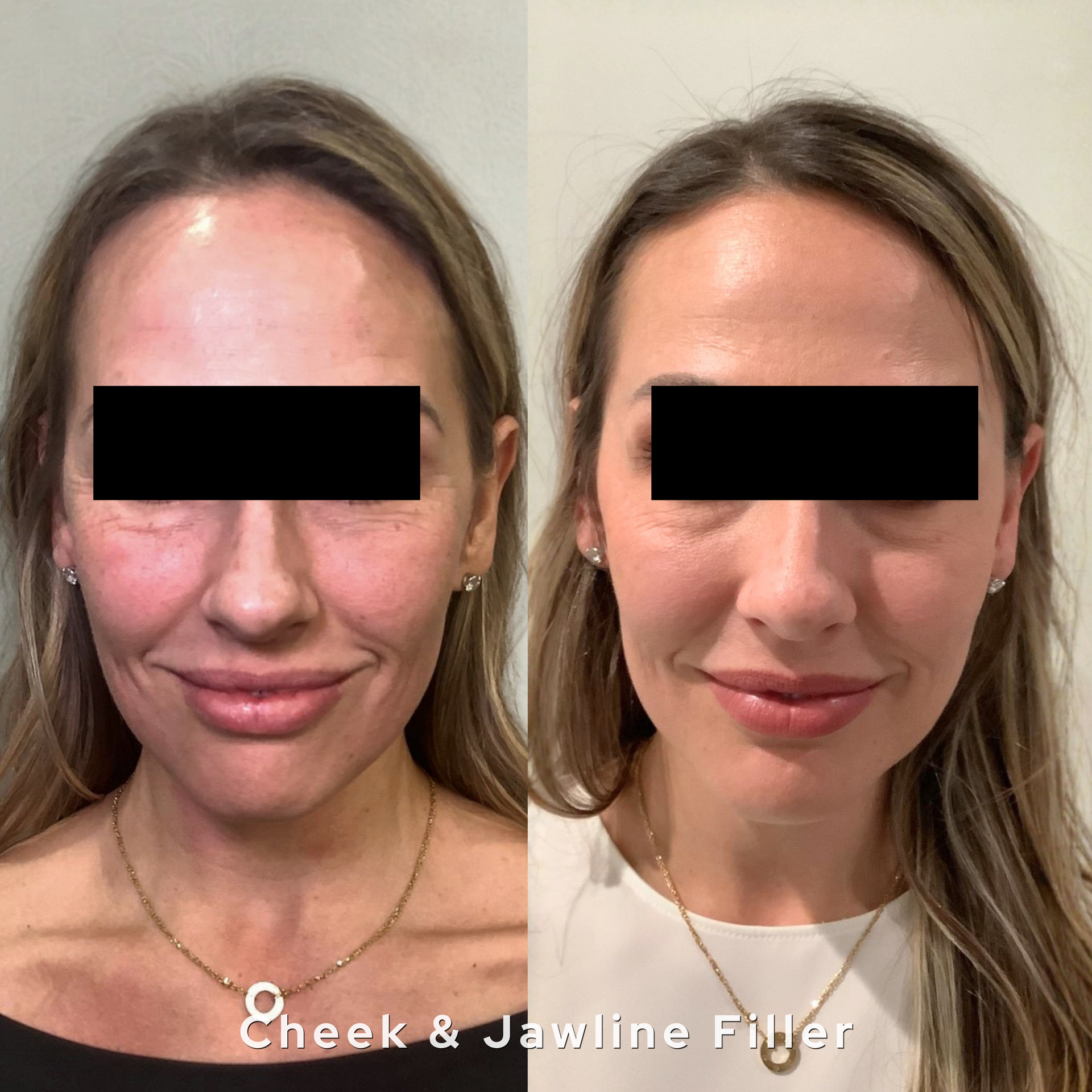 Dermal filler before and after AesTonic OKC