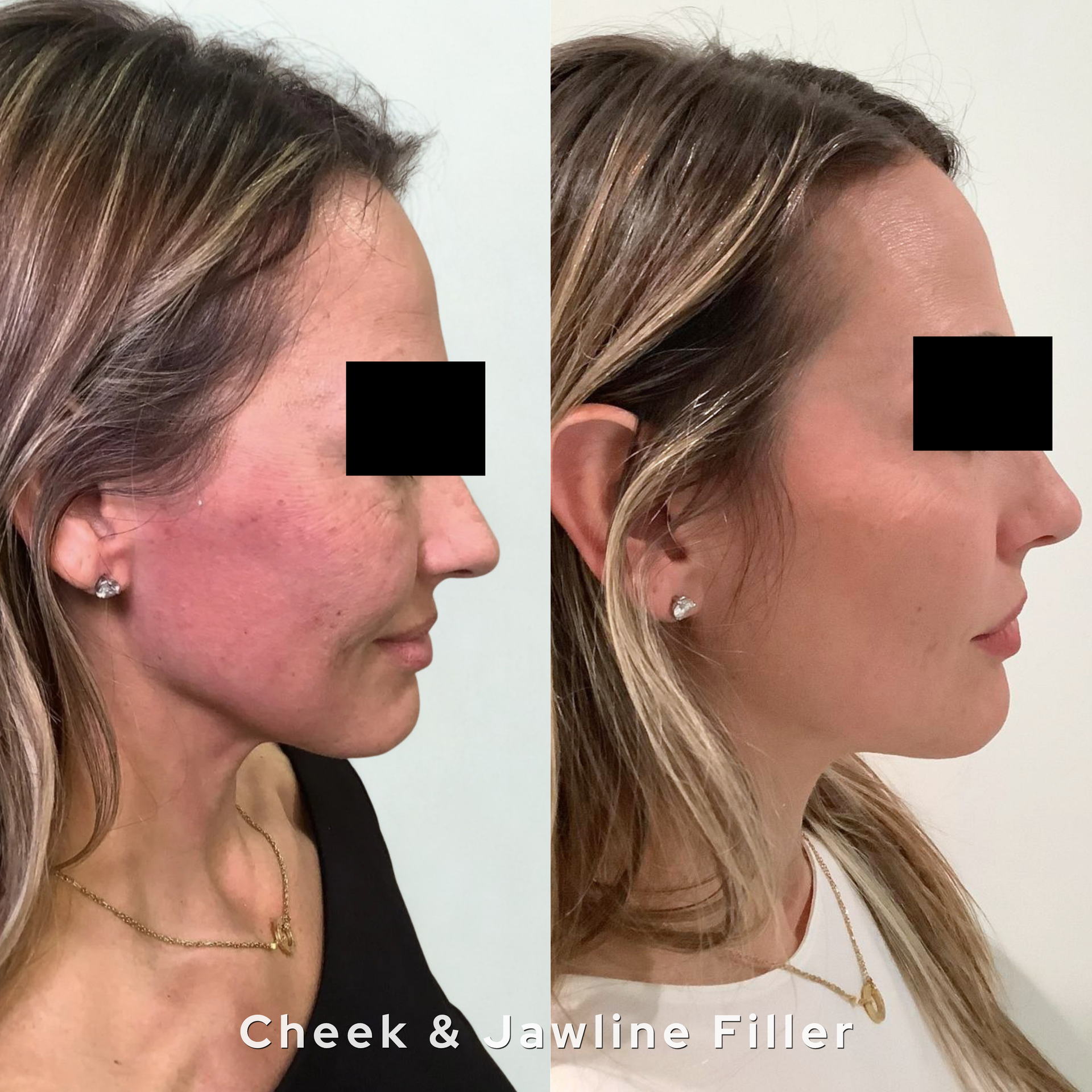Face filler results at AesTonic Med Spa