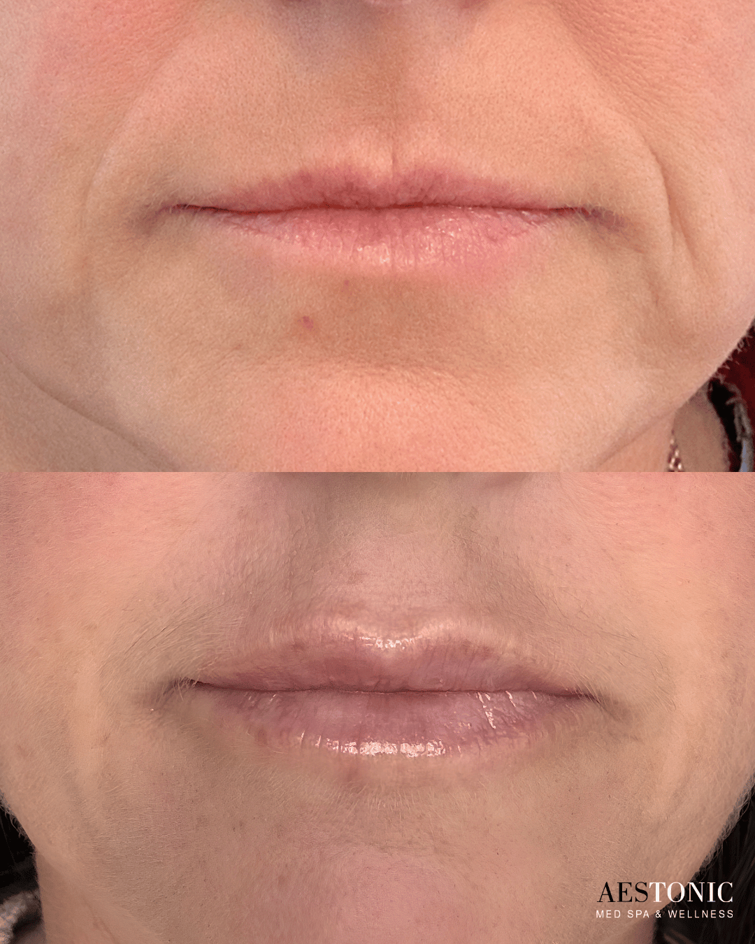 Lip filler before and after at AesTonic Med Spa Oklahoma City