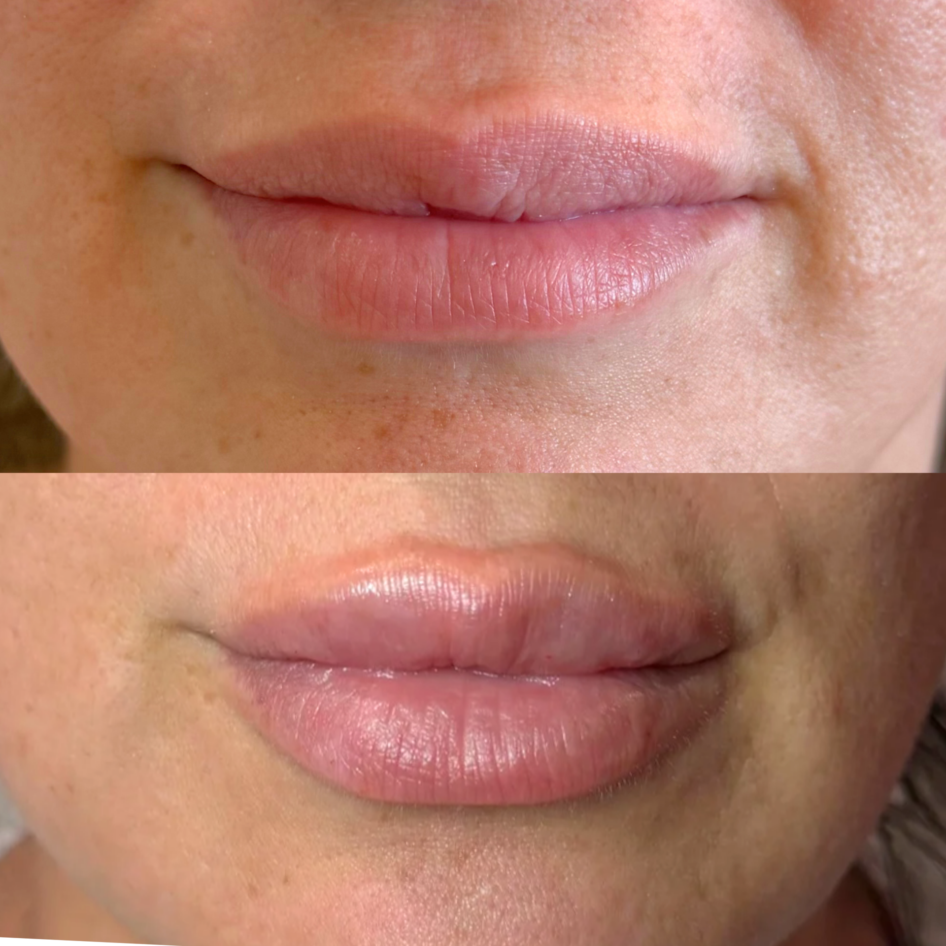 Lip filler results Oklahoma City