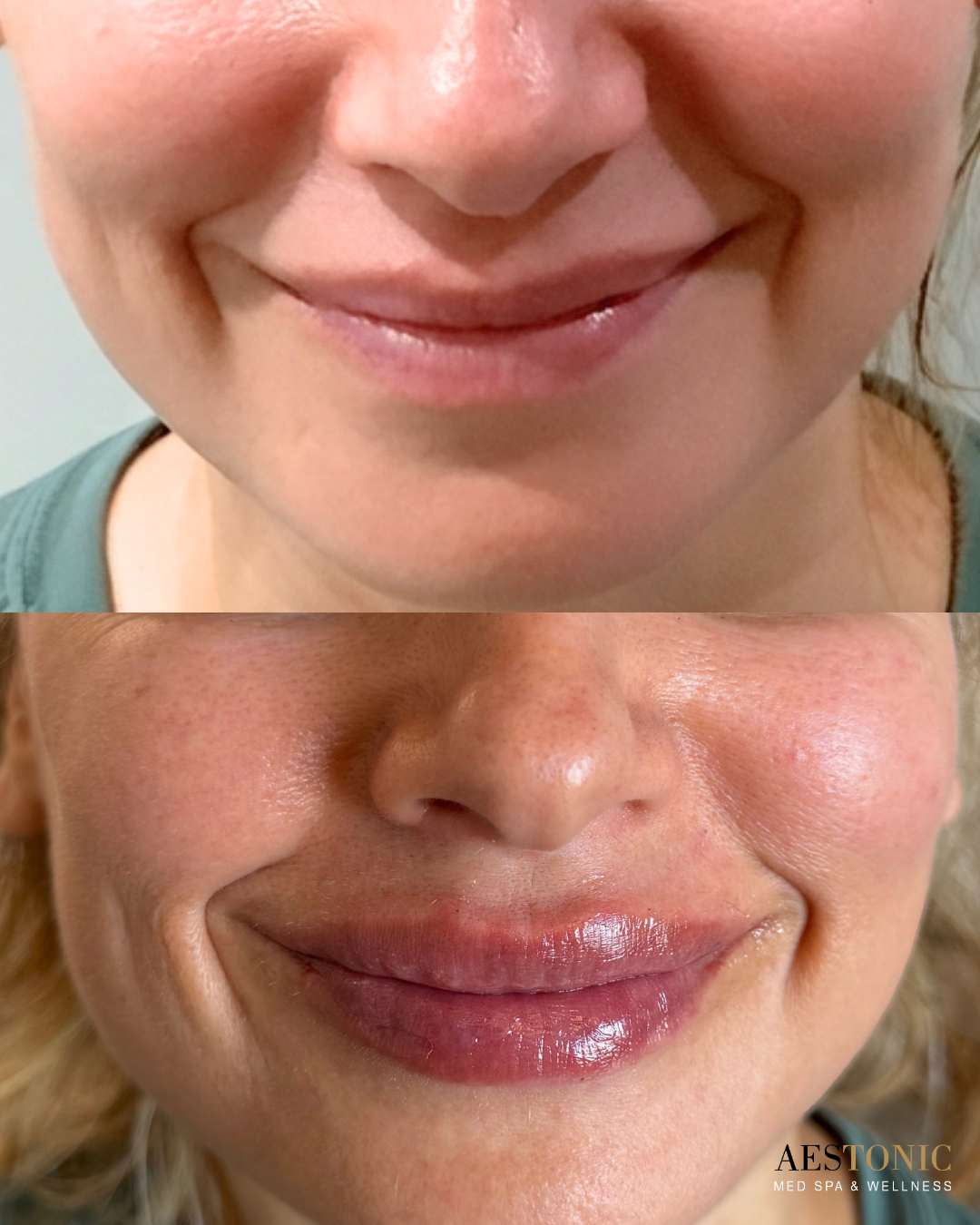 Natural lip filler before and after AesTonic