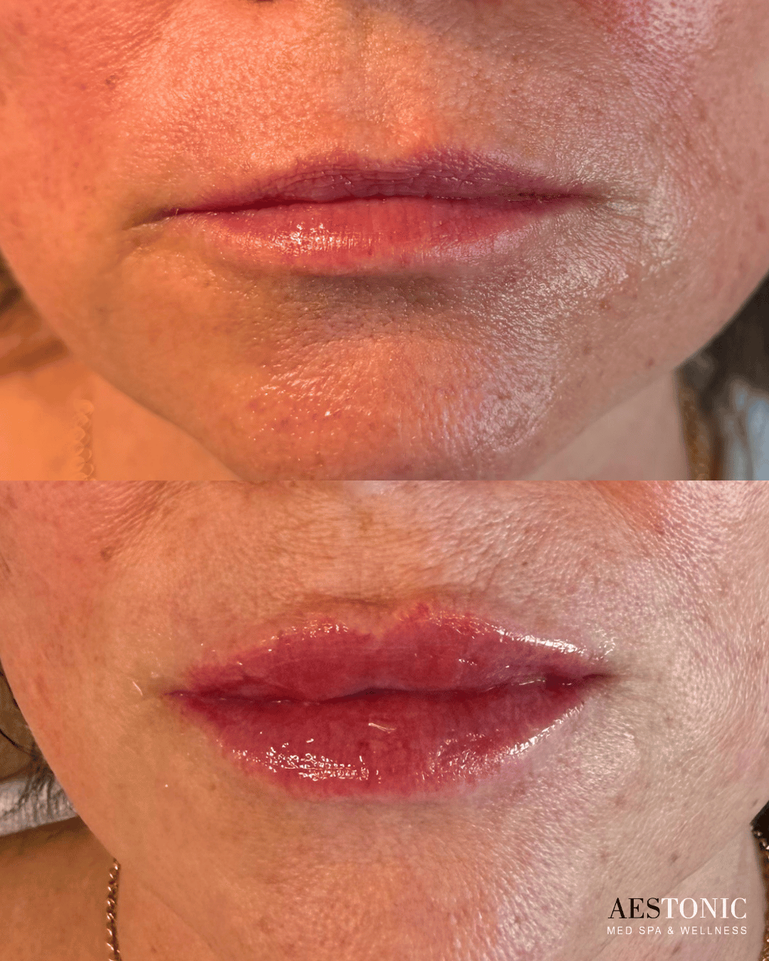 Lip filler before after OKC med spa