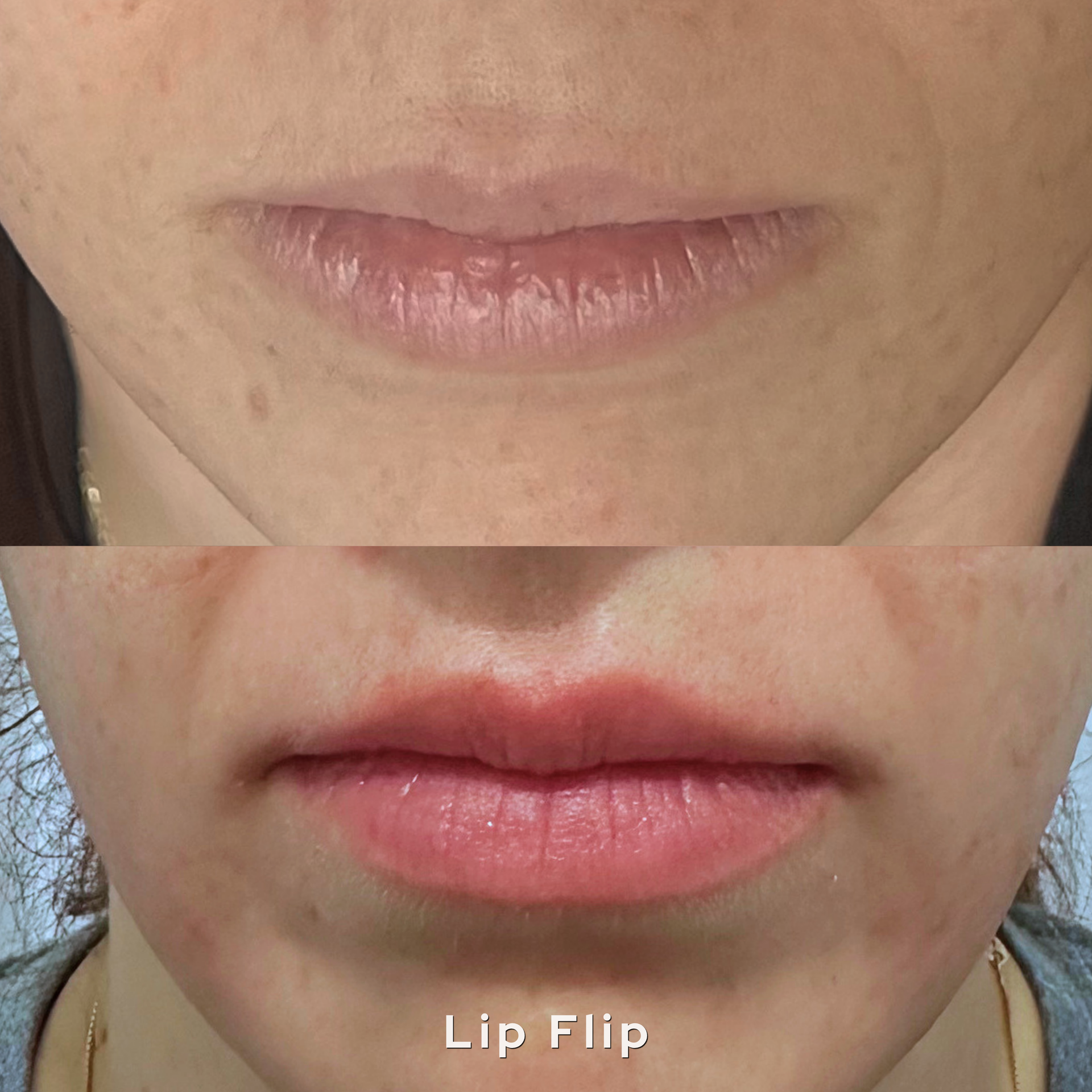 Natural lip flip before after AesTonic OKC