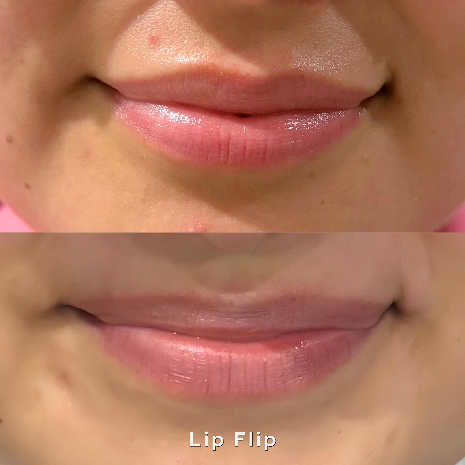 Lip flip before and after at AesTonic Med Spa Oklahoma City