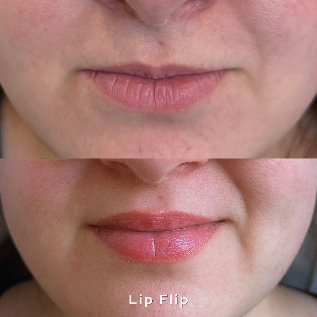 Lip Flip before and after at AesTonic Med Spa