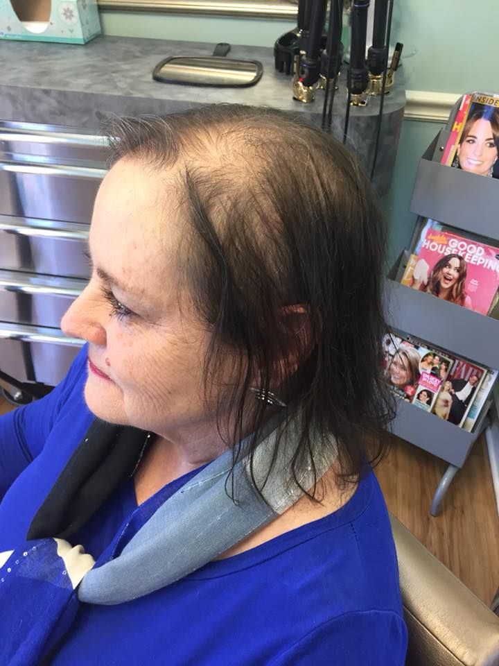 Woman with thinning dark hair in a salon, wearing a blue shirt and neck wrap.