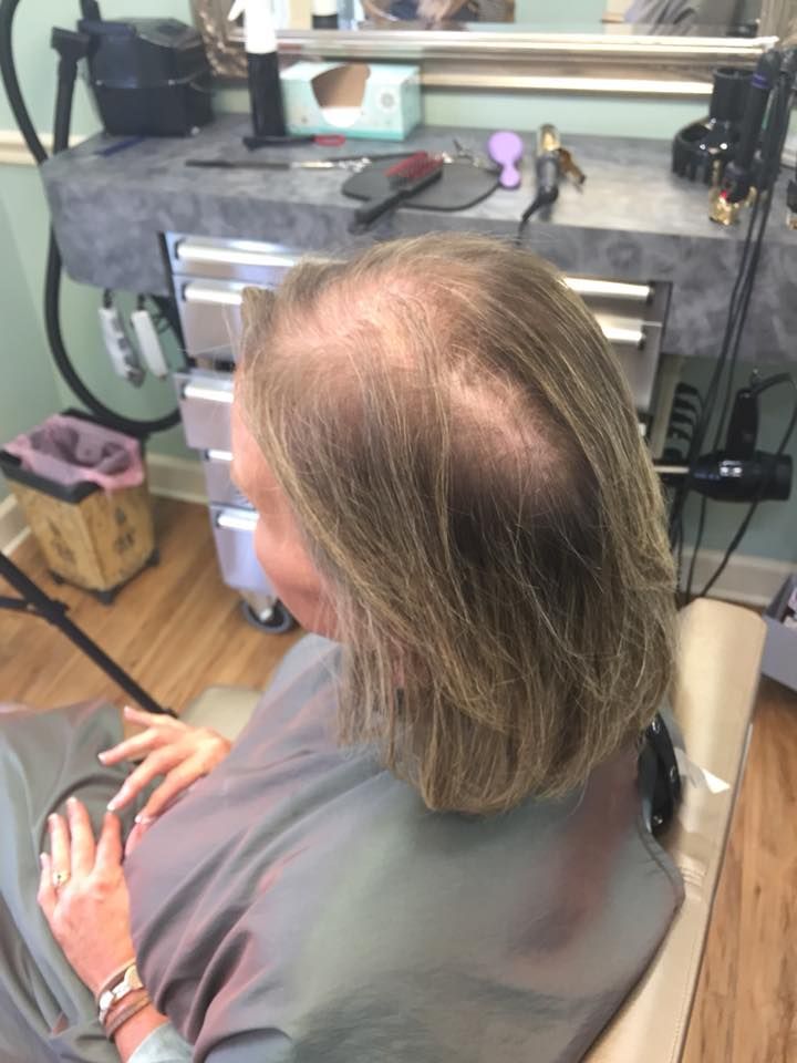 Woman with light brown hair, sitting in a salon chair. Visible thinning on top of the head.