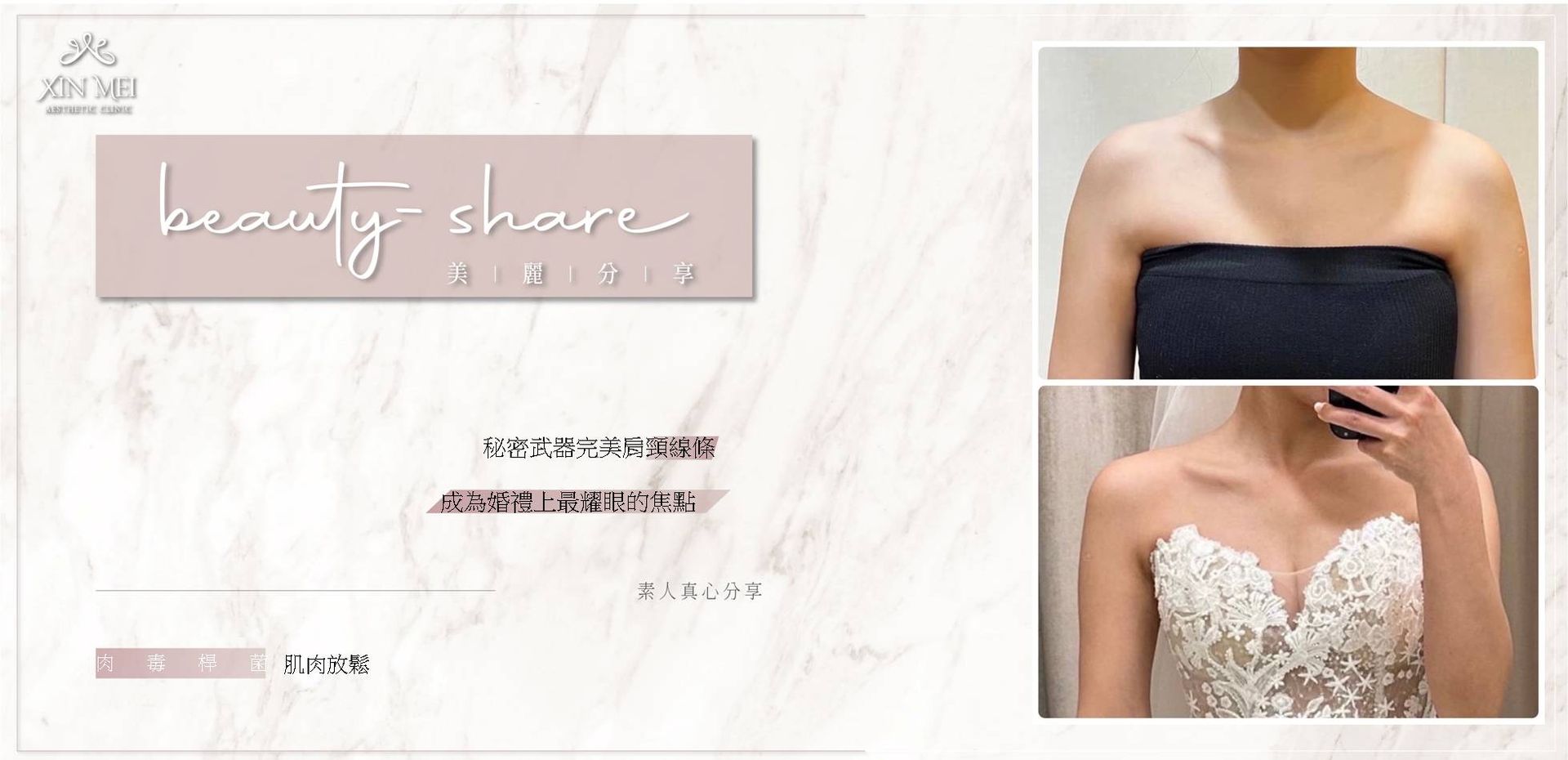 【分享】素人真心分享 ｜肉毒肩膀