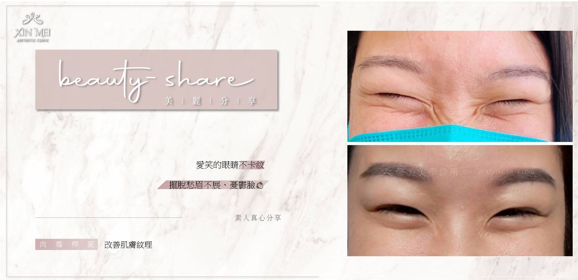 【分享】素人真心分享 ｜肉毒動態紋