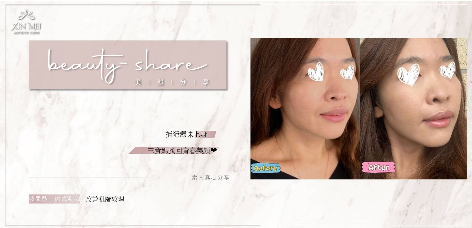 【分享】素人真心分享｜玻尿酸．肉毒動態紋